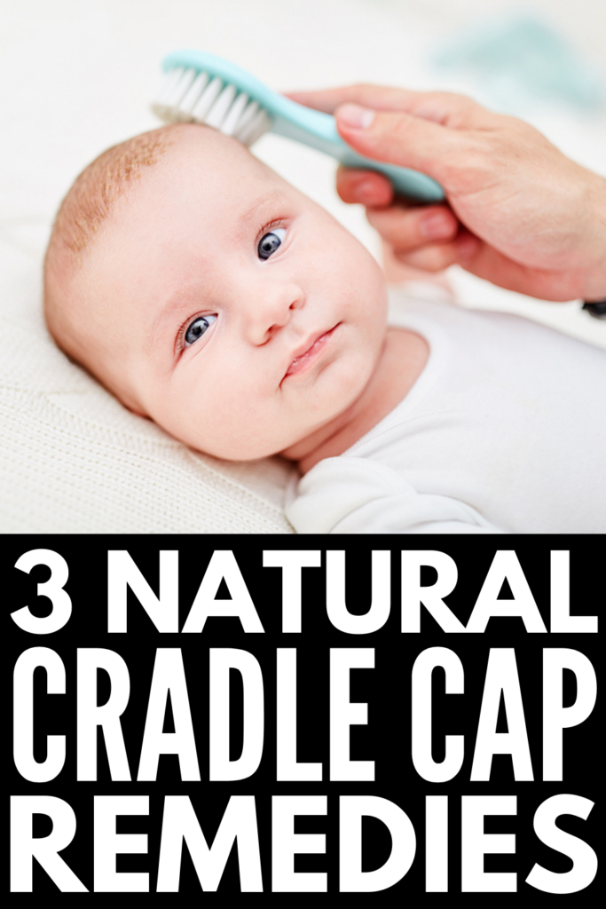 3 Natural Cradle Cap Remedies for Babies and Kids | If you want to know how to get rid of cradle cap, this post is for you! Whether you need natural remedies for your newborn baby, toddler, for kids who are older, or for adults, we\'re sharing everything you need to know. Learn what causes cradle cap, the symptoms of cradle cap, when to see a doctor, prevention tips, and natural remedies that work fast! 